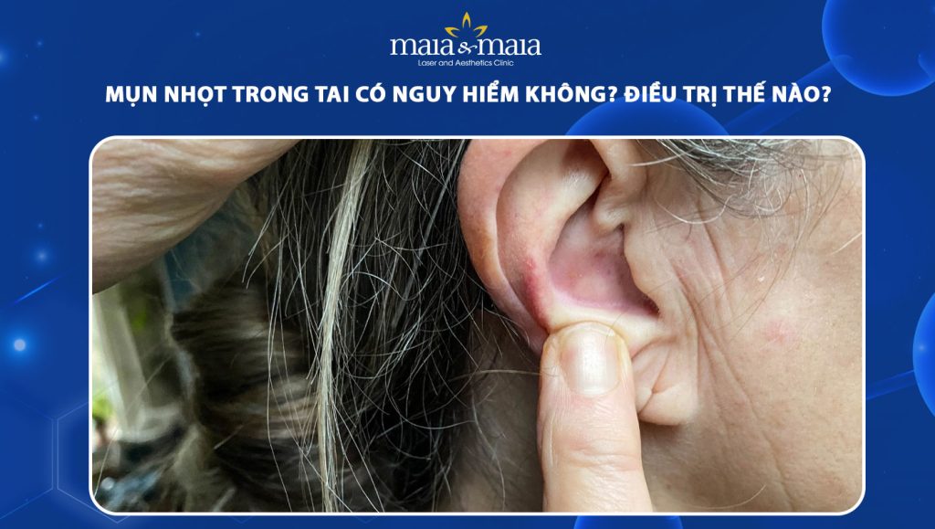 Mụn nhọt trong tai có nguy hiểm không? Điều trị như thế nào? 1 mụn nhọt trong tai