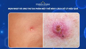 mụn nhọt và ung thư da