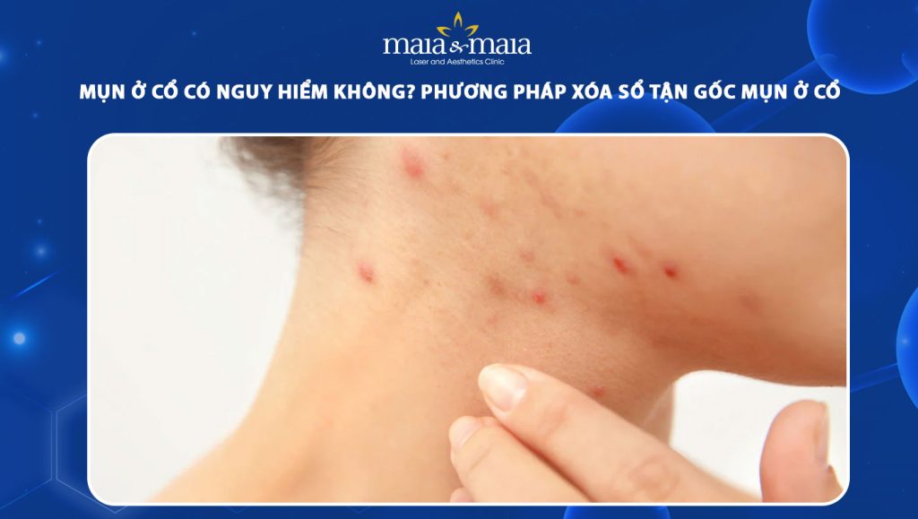 mụn ở cổ