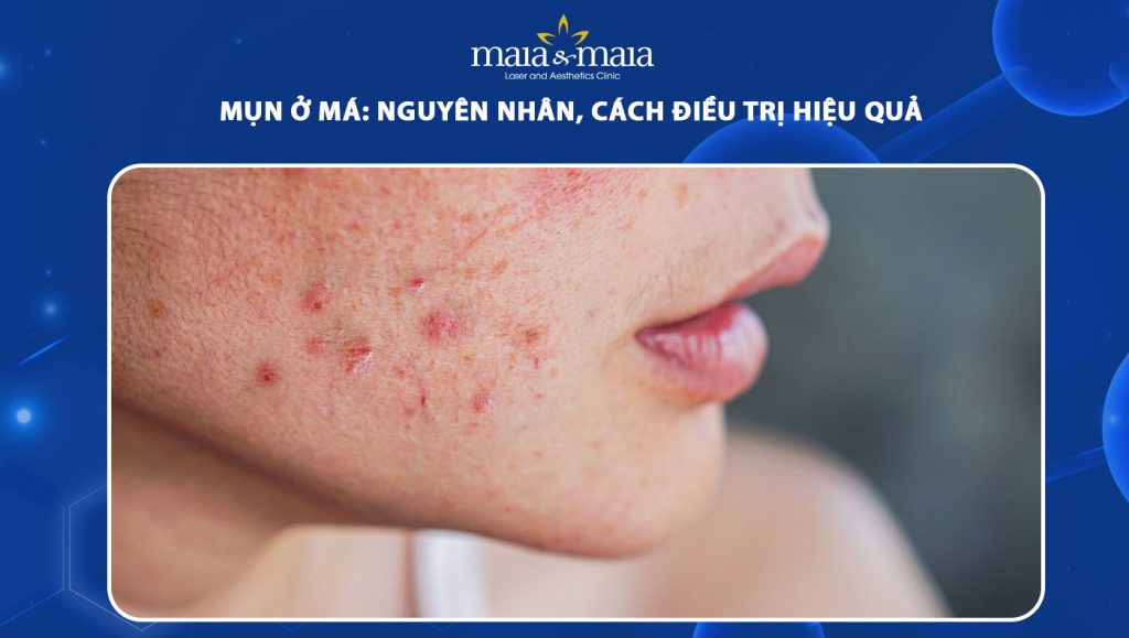 Mụn ở má có nên nặn không? Cách điều trị khoa học, hiệu quả 1 mụn ở má