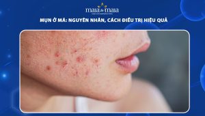mụn ở má