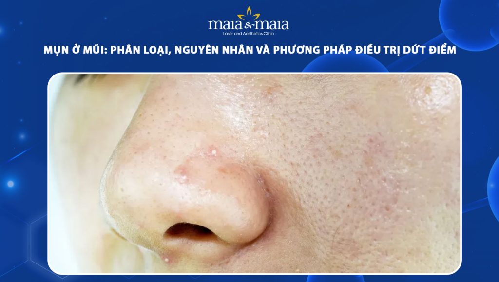 Mụn ở mũi: Phân loại, nguyên nhân và phương pháp điều trị 1 mụn ở mũi