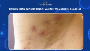 mụn ở nách