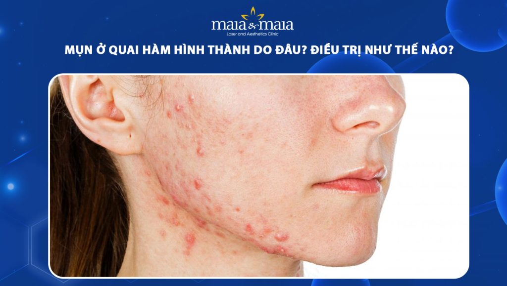 Mụn ở quai hàm hình thành do đâu? Điều trị như thế nào? 1 mụn ở quai hàm