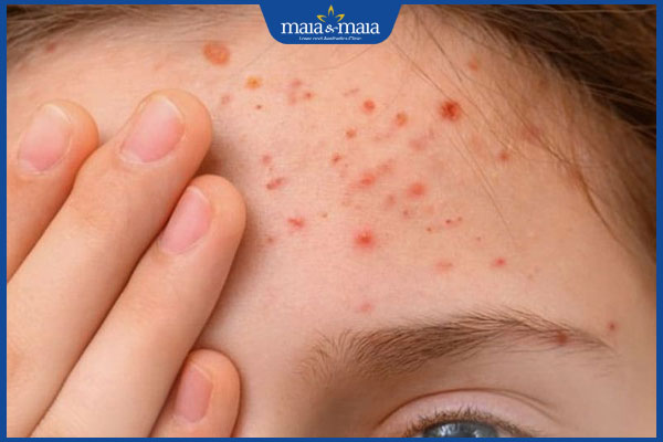 mụn ở trán bị vỡ