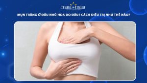 mụn trắng ở đầu nhũ hoa