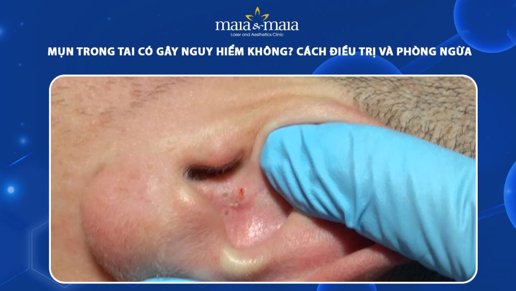 Mụn trong tai nguy hiểm không? Cách điều trị và phòng ngừa 1 mụn trong tai