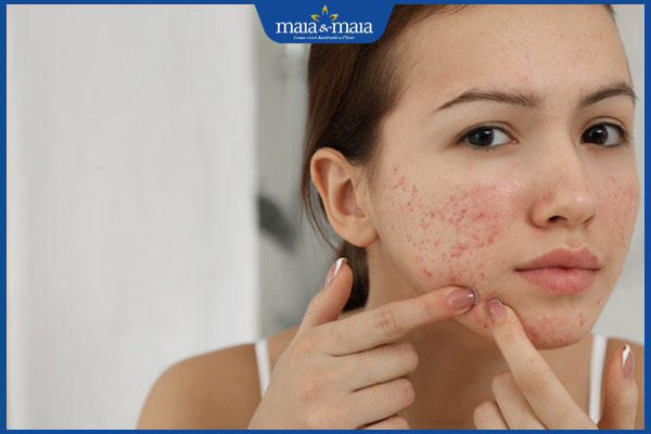 Những sai lầm khi chăm sóc da mụn nhiều người đang mắc phải 3 nặn mụn ở má