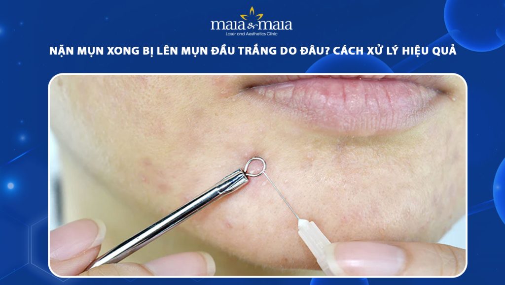 Nặn mụn xong bị lên mụn đầu trắng do đâu? Cách xử lý phù hợp 1 nặn mụn xong bị lên mụn đầu trắng