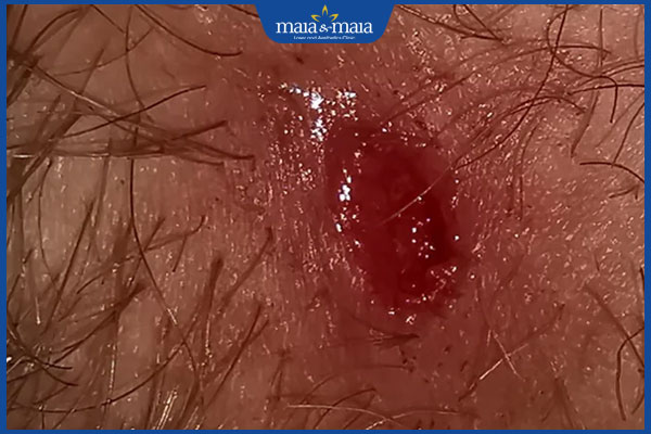 nguy hiểm của mụn nhọt vùng kín