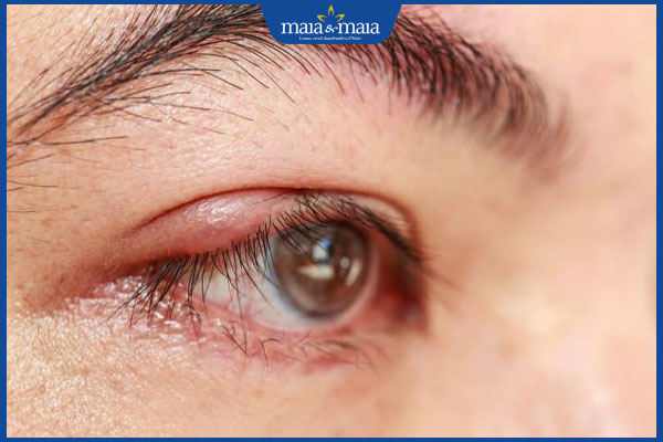 Trong mắt nổi mụn trắng nhỏ có sao không? Điều trị thế nào? 3 nguy hiểm khi nổi mụn ở mắt