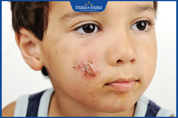 nguy hiểm khi trẻ bị nhọt