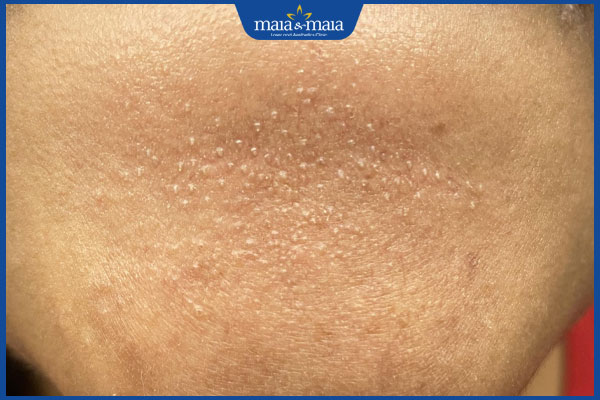 Nguyên nhân gây nên mụn cám ở cằm là gì? Điều trị như thế nào? 2 nhận biết mụn cám ở cằm