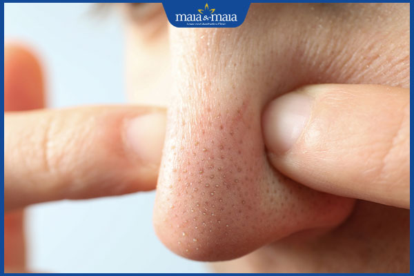 nhận biết mụn cám ở mũi