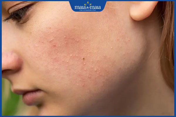 nhận biết mụn đầu trắng