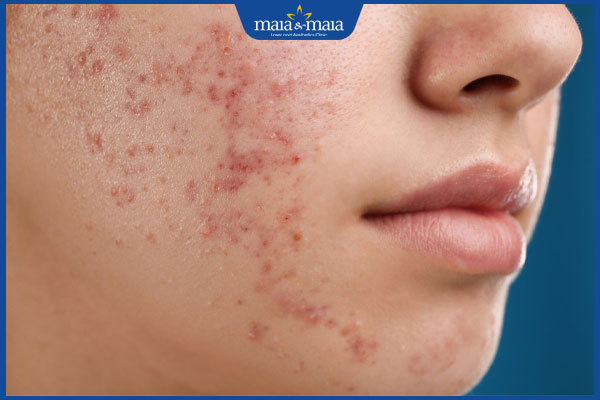 nhận biết mụn nấm men