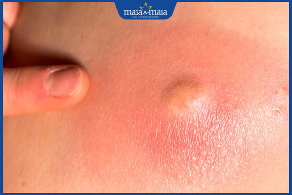 Mụn nhọt ở bụng do đâu? Giải pháp điều trị hiệu quả, an toàn 2 nhận biết mụn nhọt ở bụng