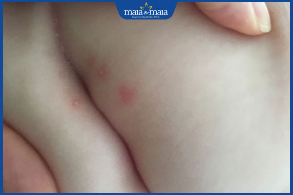 nhận biết mụn nhọt ở mông trẻ em