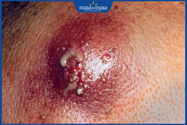 Cách xử lý mụn nhọt ở mông bị vỡ và lưu ý khi thực hiện 2 nhọt ở mông bị vỡ