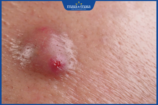 nổi mụn cứng ở vùng kín