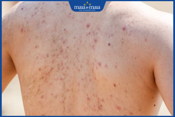 Thận yếu gây mụn hay không? Làm sao để cải thiện làn da mụn? 2 nổi mụn lưng ở nam giới