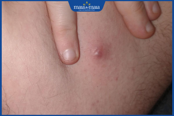 Mụn nhọt ở háng là như thế nào? Làm sao để loại bỏ mụn? 2 nổi mụn nhọt ở háng