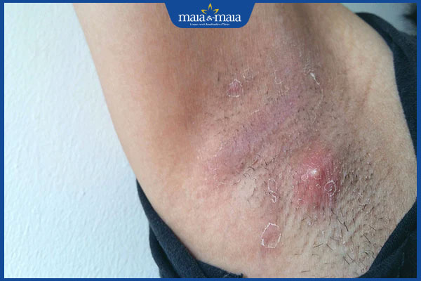 Mụn nhọt ở nách: Nguyên nhân và cách điều trị hiệu quả 2 nối mụn nhọt ở nách