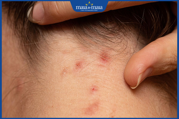 Mụn nhọt sau gáy có nguy hiểm không? Cách điều trị dứt điểm 2 nổi mụn nhọt sau gáy