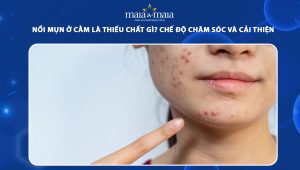 nổi mụn ở cằm là thiếu chất gì