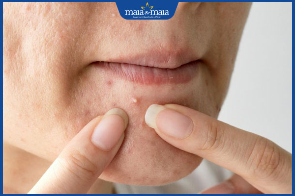 nổi mụn ở cằm