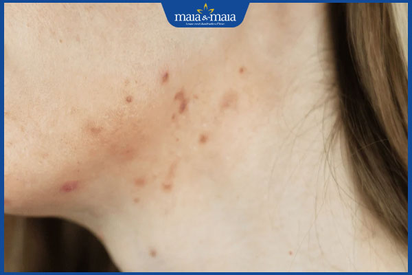 nổi mụn ở cổ