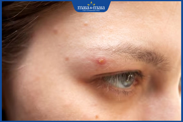 Đoán bệnh qua những vị trí mụn trên khuôn mặt 5 nổi mụn ở lông mày