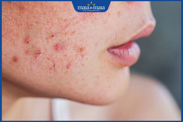 Đoán bệnh qua những vị trí mụn trên khuôn mặt 4 nổi mụn ở má