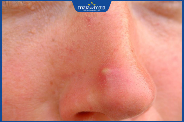 Đoán bệnh qua những vị trí mụn trên khuôn mặt 3 nổi mụn ở mũi