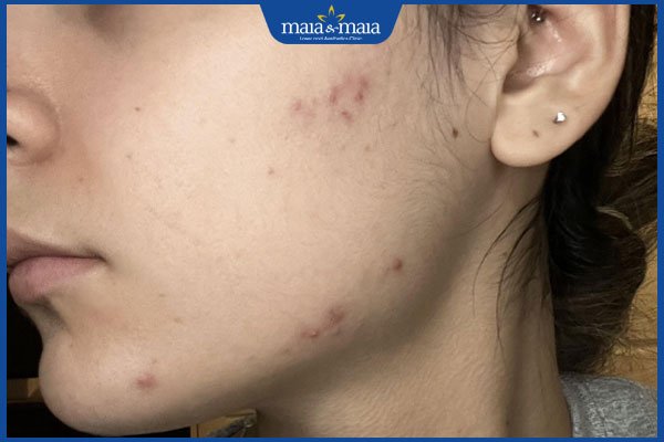 Mụn ở quai hàm hình thành do đâu? Điều trị như thế nào? 3 nổi mụn ở quai hàm