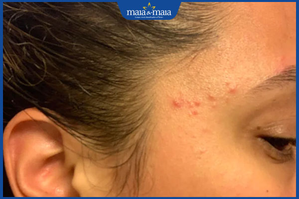 Đoán bệnh qua những vị trí mụn trên khuôn mặt 6 nổi mụn ở thái dương