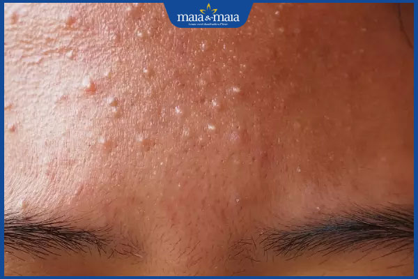 nổi mụn ở trán