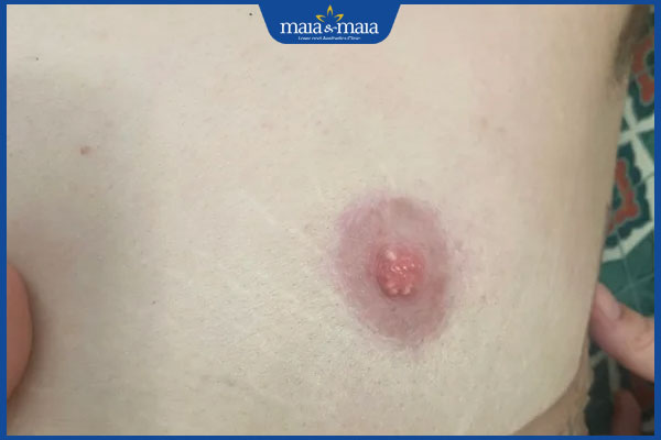 nổi mụn trắng ở đầu nhũ hoa