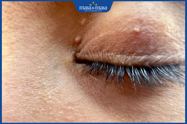 nổi mụn trắng ở mí mắt