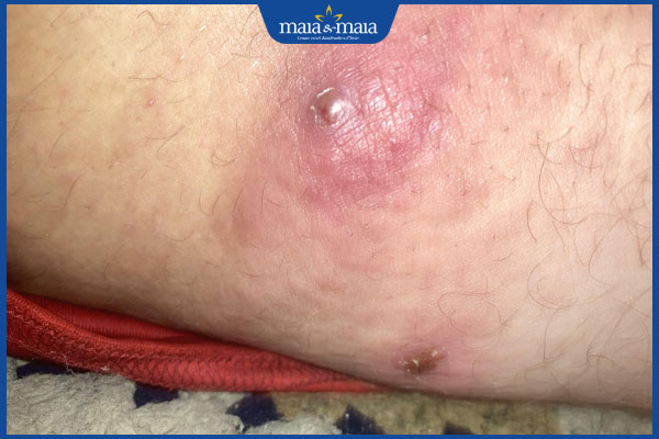 nổi nhọt ở chân