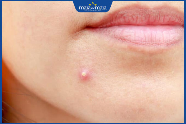 nổi nhọt ở mặt