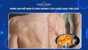 nóng gan nổi mụn ở lưng