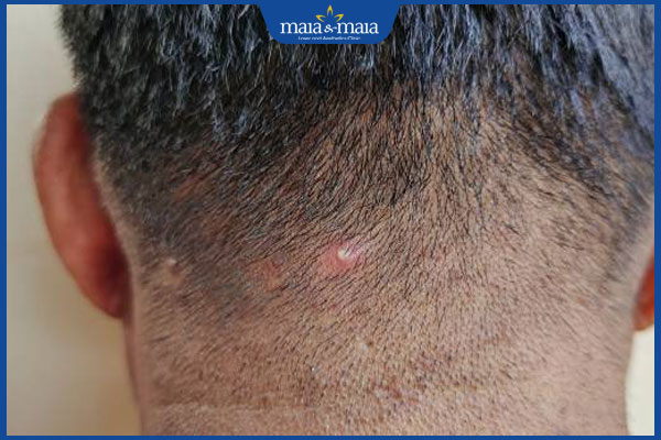 Mụn nhọt trên da đầu do đâu? Cách điều trị và phòng ngừa 2 nốt nhọt trên da đầu