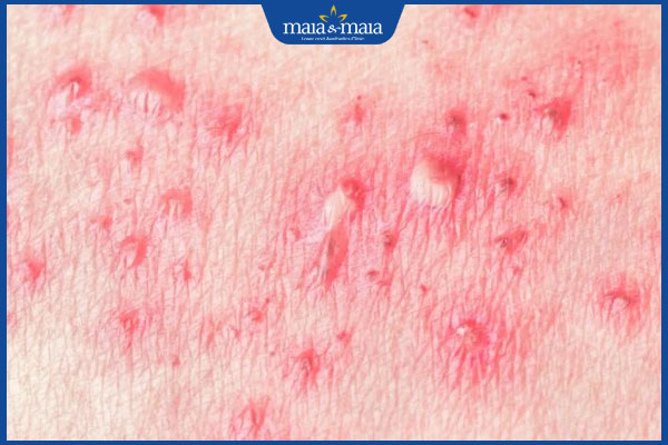 phát ban vùng kín