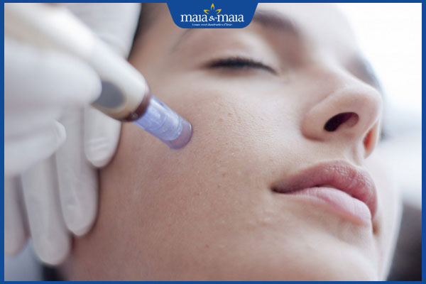 Phi kim trị mụn có tốt không? Ưu và nhược điểm khi thực hiện 2 phương pháp phi kim trị mụn