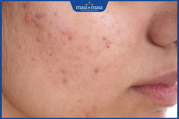 rủi ro khi nặn mụn tại nhà