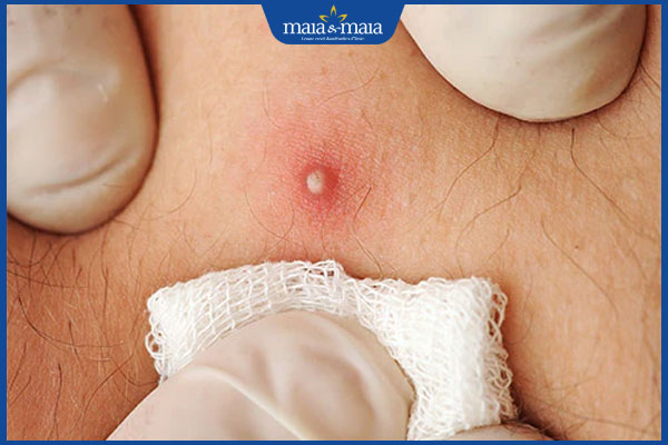 Cách xử lý mụn nhọt ở mông bị vỡ và lưu ý khi thực hiện 3 sát trùng vết mụn