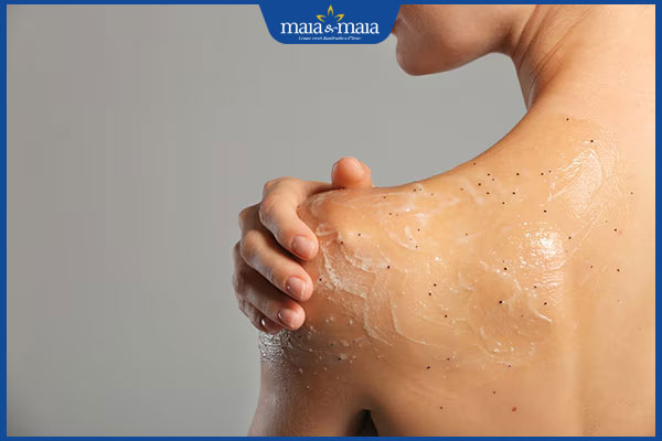 Mụn lưng tuổi dậy thì có tự hết không? Giải pháp cải thiện hiệu quả 3 tẩy tế bào chết body