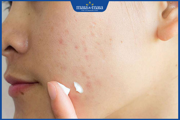 Cách trị mụn đầu đen và lỗ chân lông to không nên bỏ qua 3 thoa kem trị mụn đầu đen và lỗ chân lông to