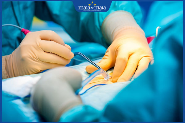 thực hiện đốt điện trị hạt cơm